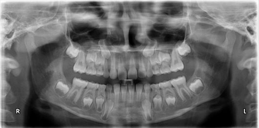 Ortopantomograma (OPG) / Panoramic X-Ray  