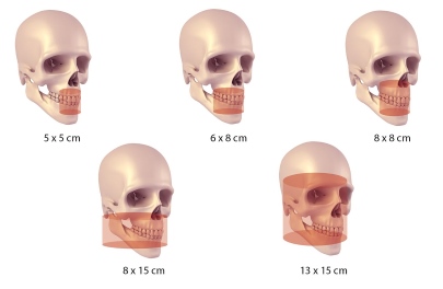 Volume Radiografii 3D CRANEX3D