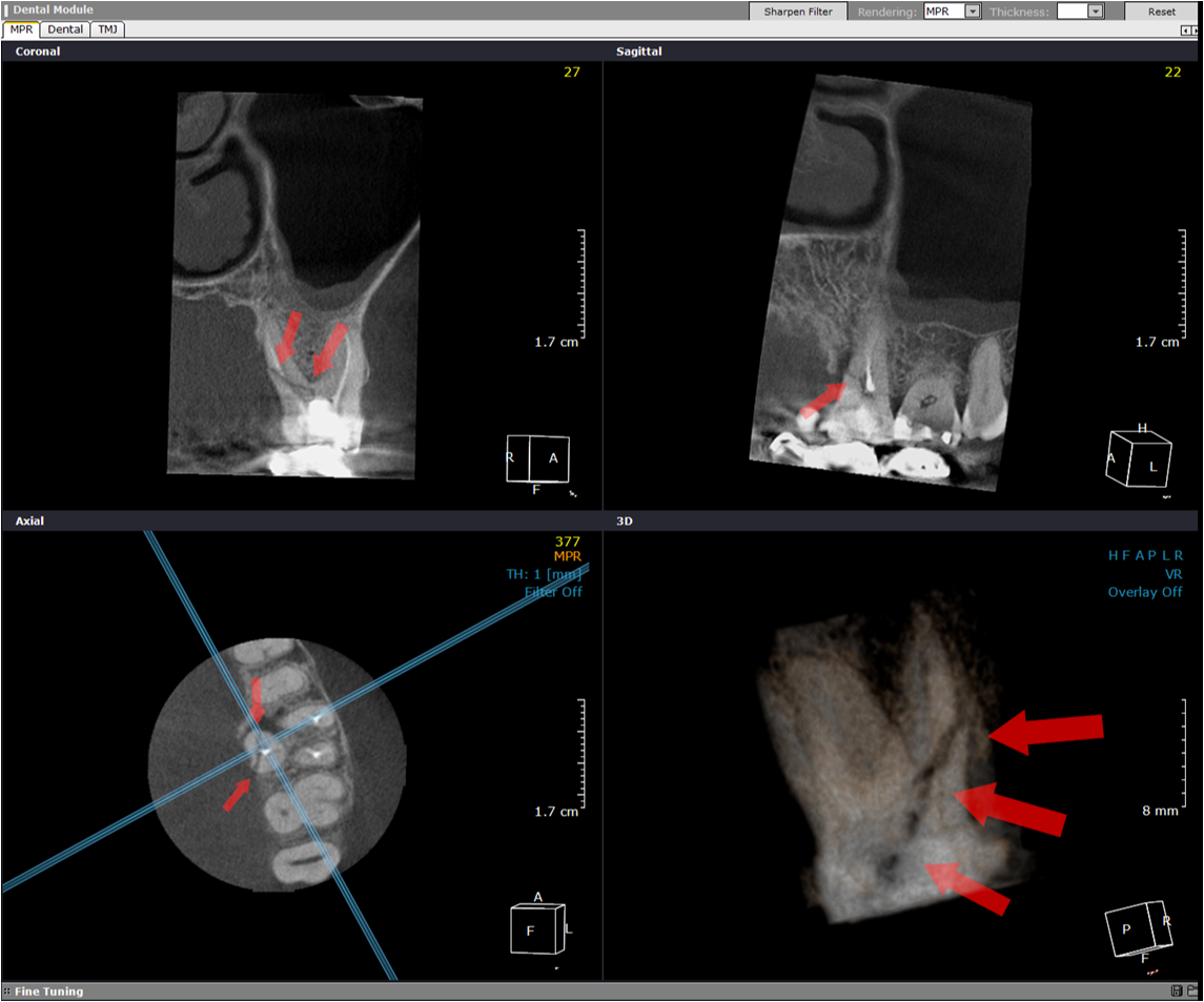 Radiografii 3D CRANEX3D
