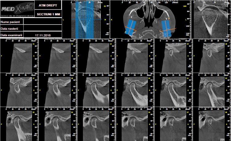 Radiografii 3D ATM Dreapta