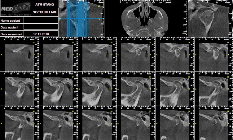 Radiografii 3D ATM Stanga