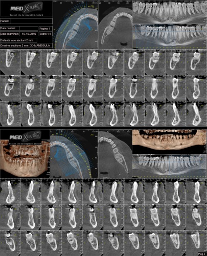 Radiografii mandibula 3D CRANEX3D