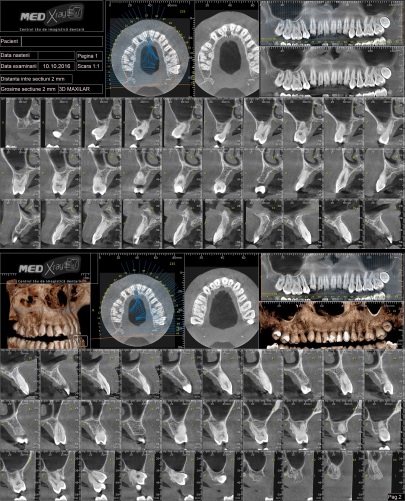 Radiografii maxilar 3D CRANEX3D