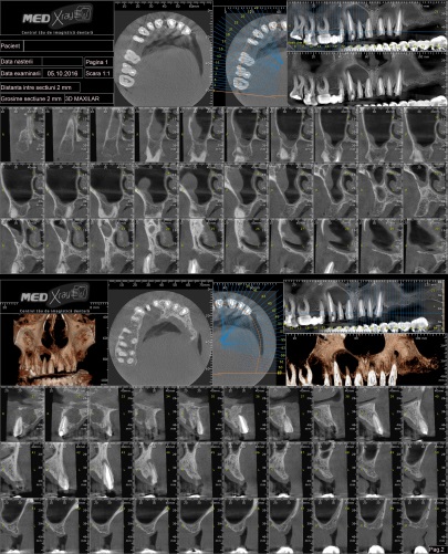 Radiografii maxilar 3D CRANEX3D