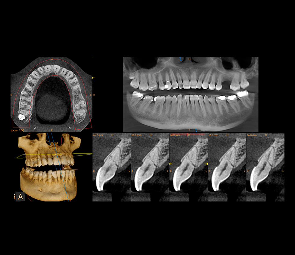 Radiografii maxilar 3D CRANEX3D