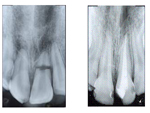 Radiografii retroalveolare (Individual Periapicals X-Ray)