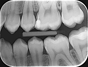 Radiografie retroalveolara interproximala x4 (Bite wings x4)