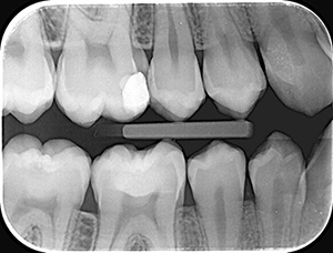 Radiografie retroalveolara interproximala x4 (Bite wings x4)