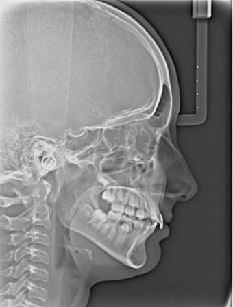 Teleradiografie / Cephalometric X-Ray - de profil (lateral)