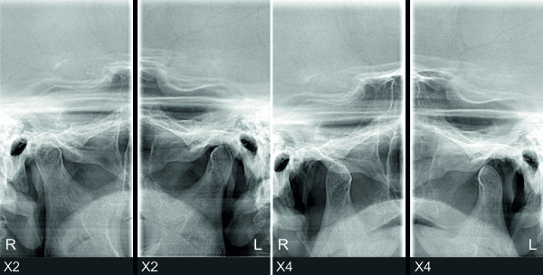 Radiografia A.T.M./ TMJ X-Ray