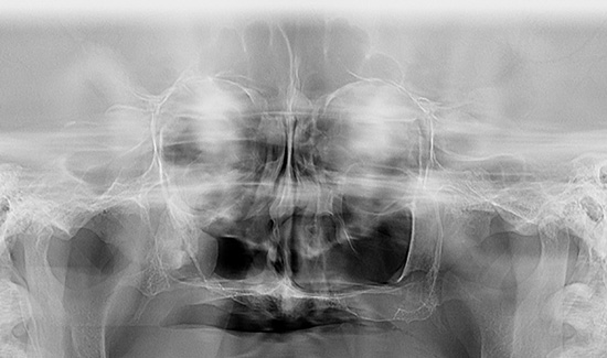 Radiografia de sinusuri/ Synus X-Ray