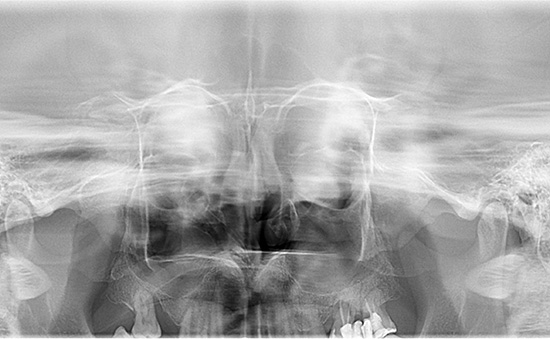 Radiografia de sinusuri/ Synus X-Ray