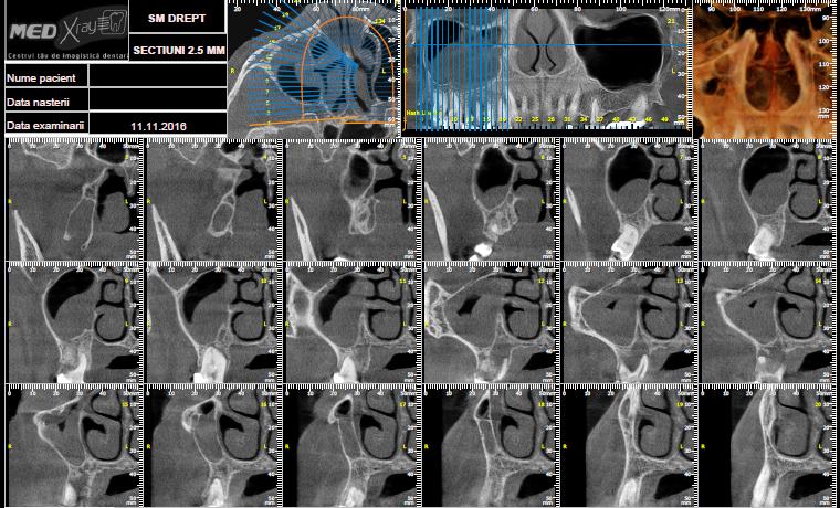 Radiografii 3D SINUS Dreapta