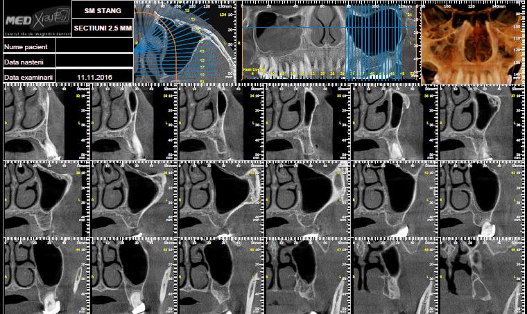 Radiografii 3D SINUS Stanga